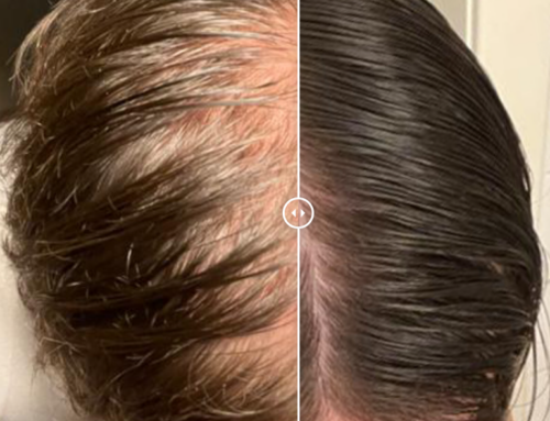 Behandlungserfolg: Plasmabehandlung gegen Haarausfall (Alopezie) bei JUVENIS in Wien