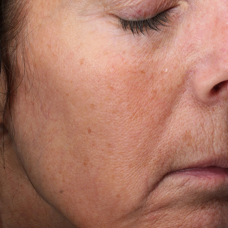 Foto des Gesichts einer Frau aufgenommen vor und nach der Behandlung mit dem Potenza Radiofrequenz-Microneedling