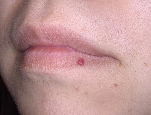 Behandlungserfolg: Entfernung von einem Hämangiom mittels Nd:YAG-Lasers an der Lippe
