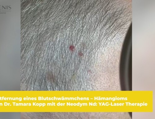 Entfernung eines Blutschwämmchens – Hämangioms mit Laser bei JUVENIS in Wien