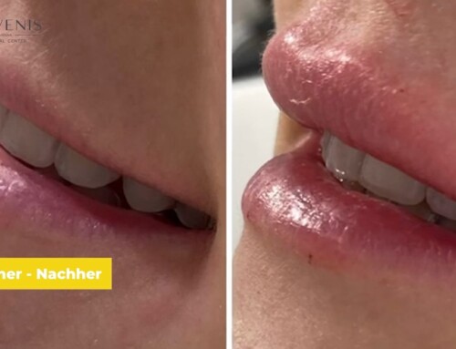 Lippenvergrößerung mit Hyaluronsäure von Hautärztin Dr. Tamara Kopp