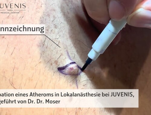 Video zu einer Exstirpation eines Atheroms in Lokalanästhesie von Dr. Dr. Bernhard Moser bei JUVENIS in Wien