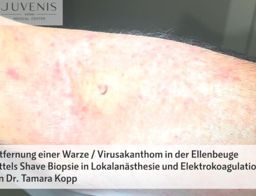 Entfernung einer Viruswarze von Dr. Tamara Kopp, Wien, JUVENIS