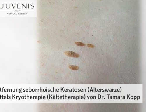 Einblick in den Ordinationstag: Entfernung Seborrhoische Keratosen – Alterswarzen